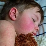 U.S. Measles Outbreaks Emphasize Vaccination Importance