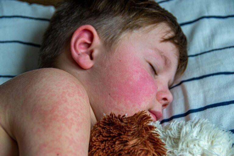 U.S. Measles Outbreaks Emphasize Vaccination Importance