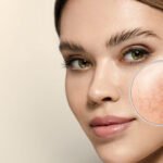 The Role of Skin Care in Rosacea Treatment